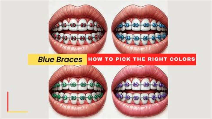 Aqua Blue Braces - How To Discuss