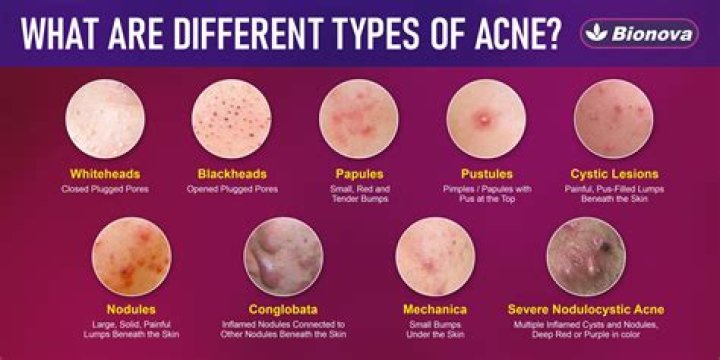 Arm acne - How To Discuss