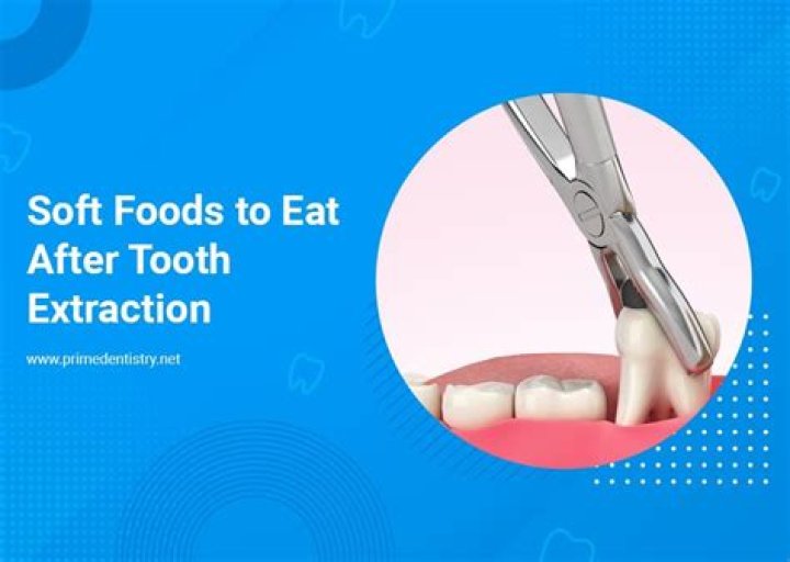 Can I Eat Noodles After Tooth Extraction
