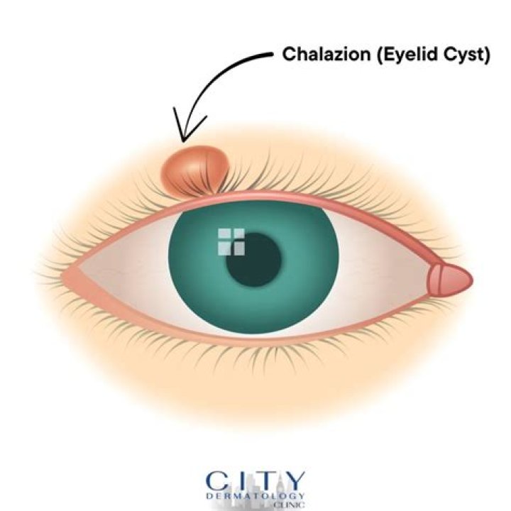 Chalazion Surgery Cost - How To Discuss
