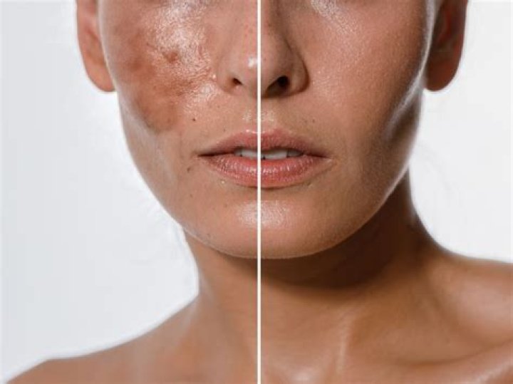 Chemical peel for hyperpigmentation - How To Discuss