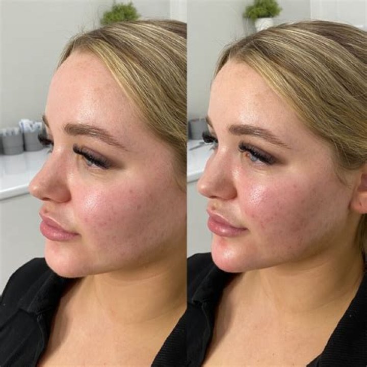 Chin Filler Before and After