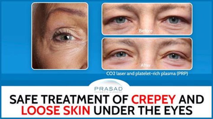 Crepey skin under eyes - How To Discuss