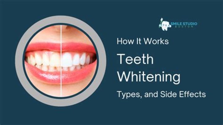 Does teeth whitening work - How To Discuss