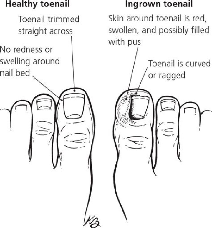 Drawing Salve Ingrown Toenail - How To Discuss