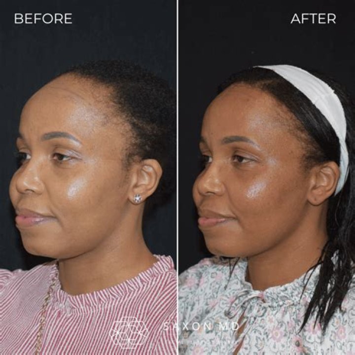 Female receding hairline - How To Discuss