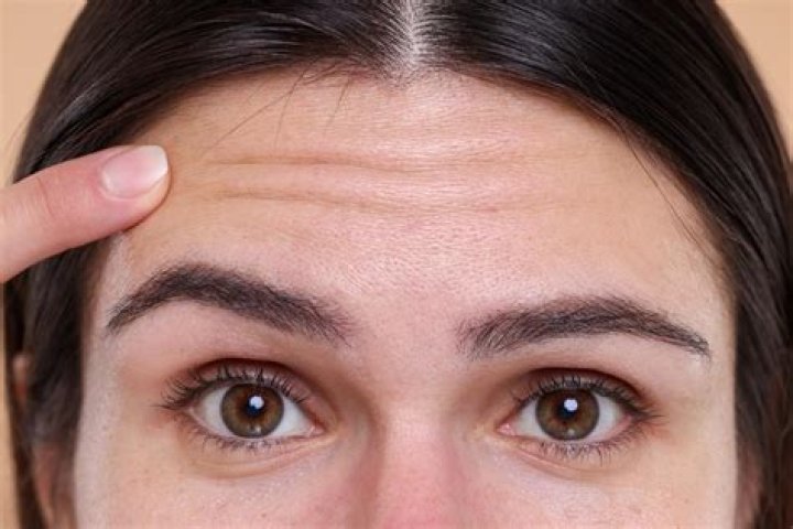 Forehead creases - How To Discuss