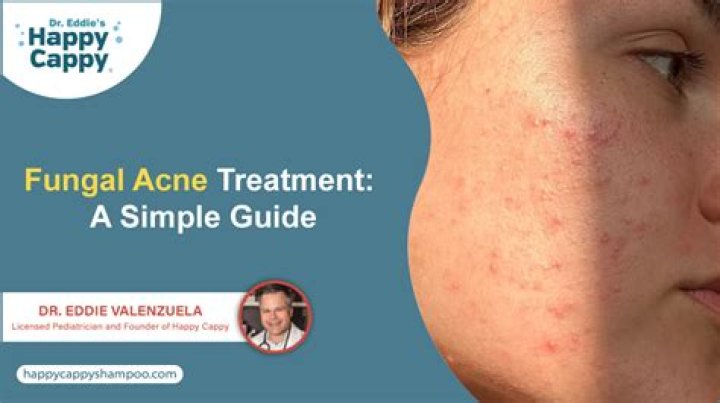 Fungal acne on face - How To Discuss