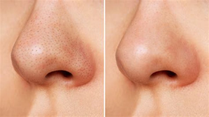 Get rid of blackheads on nose