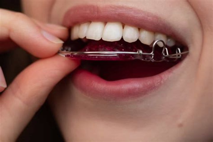 Haven T Worn My Retainer In 5 Years