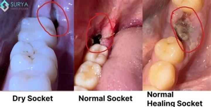 How Long Does Dry Socket Last
