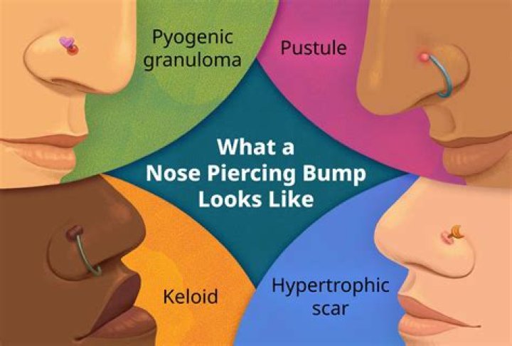 How To Get Rid Of Keloids From Nose Piercings