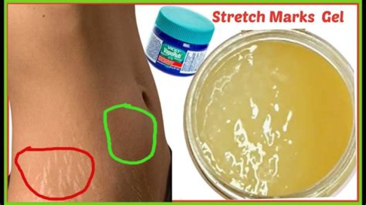 How to lighten stretch marks