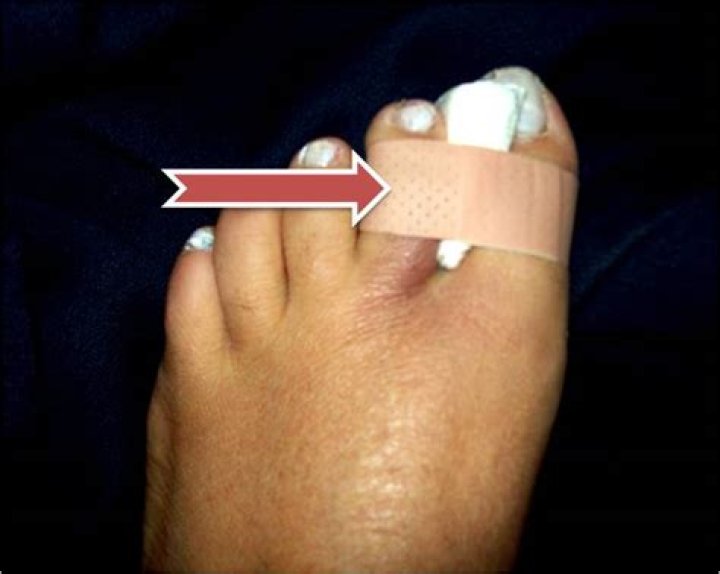 How to tape a broken toe