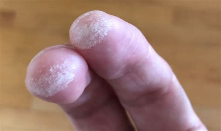 Hydrogen Peroxide Skin White Spots