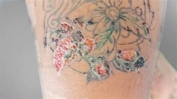 Infected tattoo treatment - How To Discuss