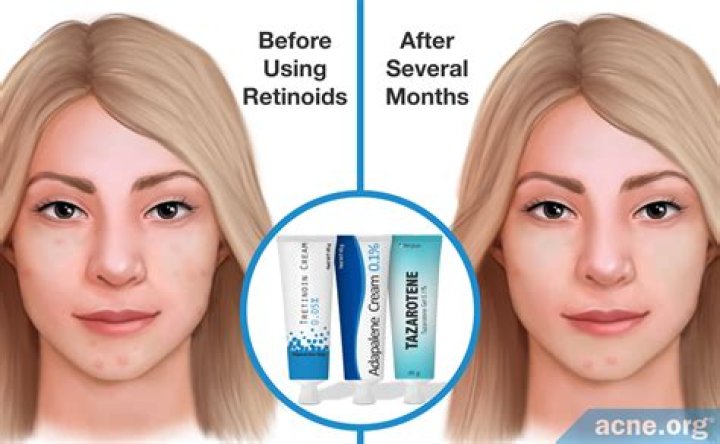 Is retinol good for acne