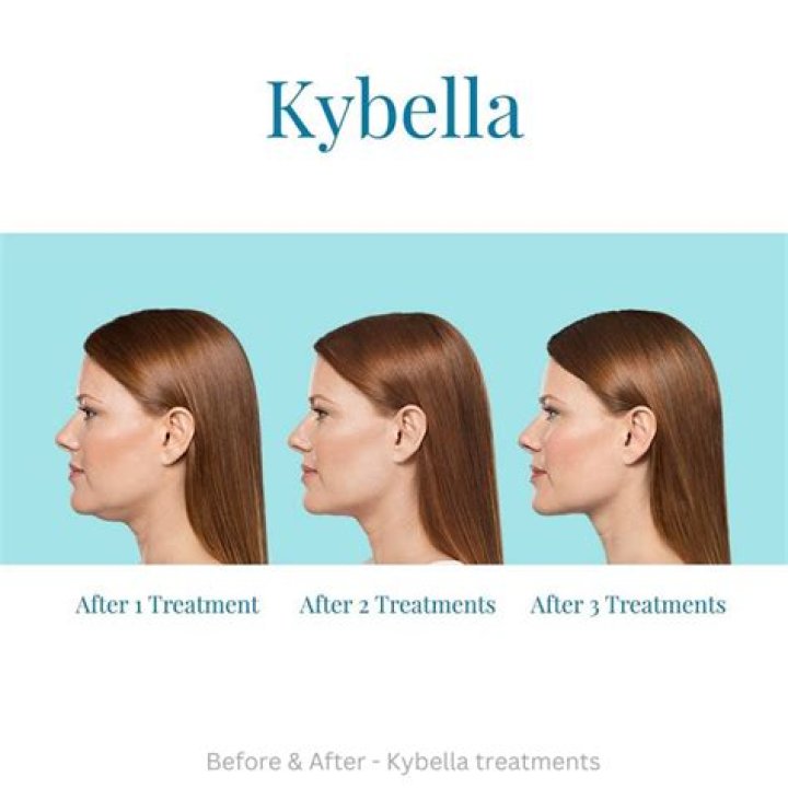 Kybella reviews - How To Discuss