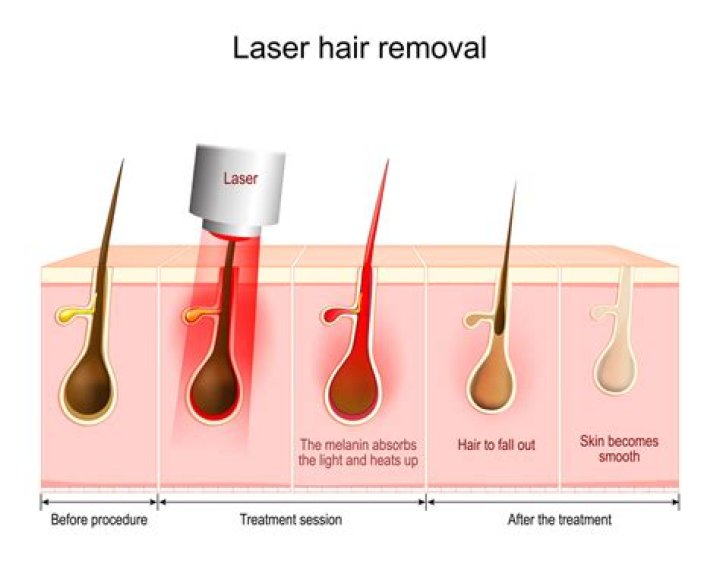 Laser Hair Removal And Diabetes