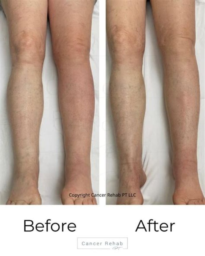 Lymphatic drainage massage before and after