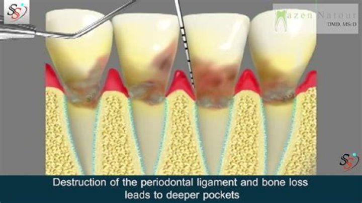 Perio Scale And Root Pin