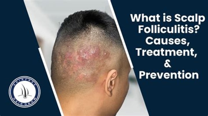 Scalp Med Hostess - How To Discuss