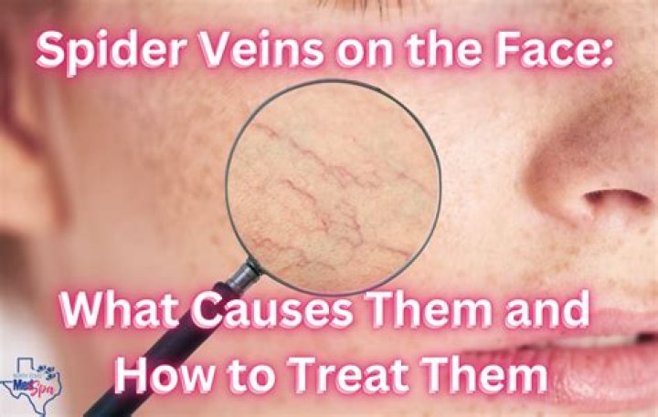 Spider veins on face - How To Discuss