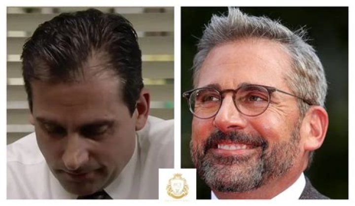 Steve Carell Hair Implants - How To Discuss