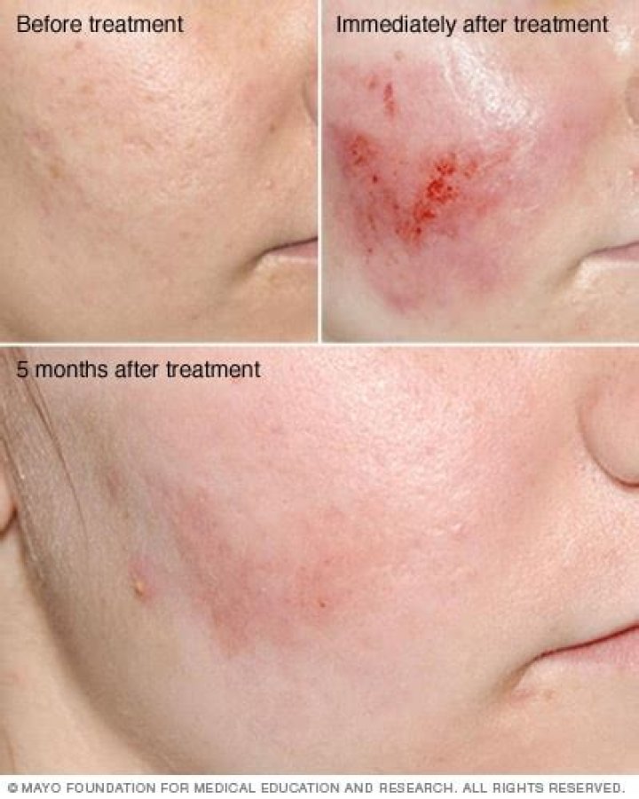 What is dermabrasion - How To Discuss