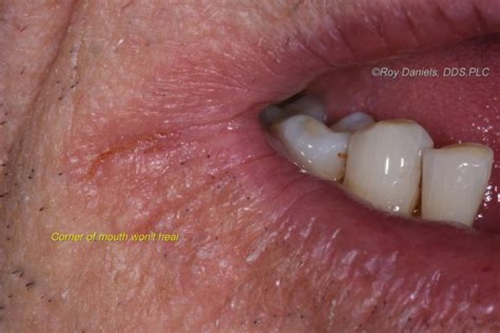 White Stuff That Accumulates At The Corner Of Your Mouth